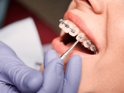 woman getting their brackets added