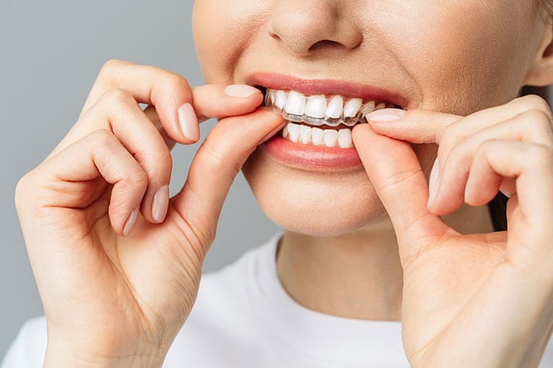 Cost of Invisalign Advanced Orthodontics Bellevue, WA