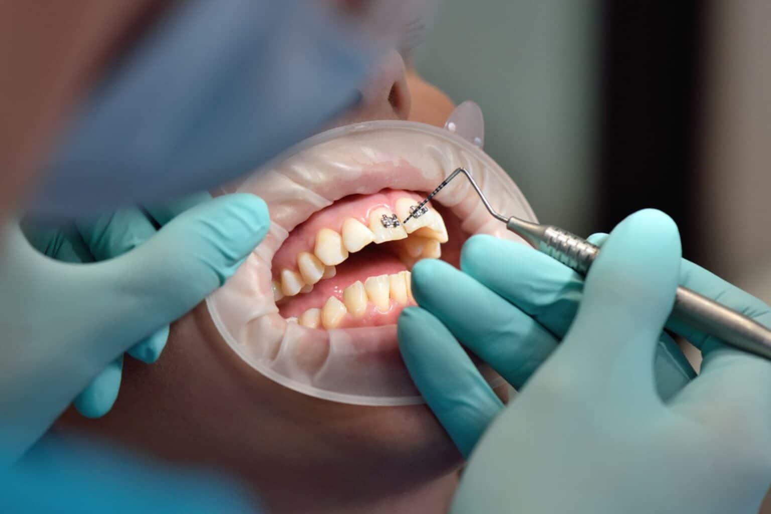 What Can Make Teeth Straightening Faster in Bellevue, WA? Advanced Orthodontics
